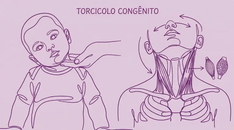 torcicolo congênito